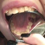 после протезирования зуба отверстие возле десны большое