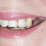 провал десны у зуба