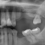 провал в десне