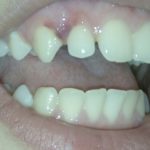 синяк на десне