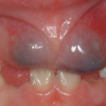 синяк на десне при прорезывании