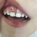 синяк на десне у ребенка