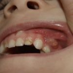 свищ на десне