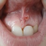 свищ на десне с кровью