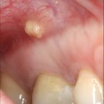 твердый свища на десне