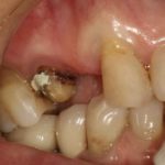 зуб провалился в десну