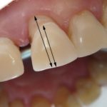 Десна отходит от зуба