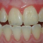 Воспаленная десна