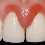 Воспалилась десна