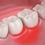 болит пульсирует десна