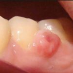 бородавка на десне