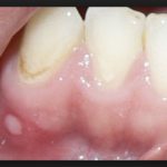 бородавка на десне фото