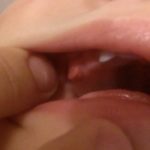 бородавка на десне у ребенка