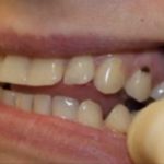 черные пятна на зубах у десны