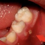 чирий на десне