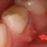 чирий на десне фото