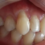 десна отходит от зуба что делать