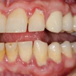 десна отошла от зуба