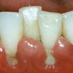 десна отошла от зуба лечение