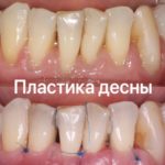 десневая пластика
