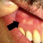 на десне чирий