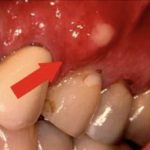 на десне появился чирий