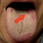 облазит язык причины