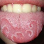 от чего шелушится язык