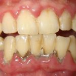 отходит десна от зуба мудрости