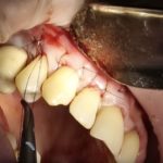 пластика десны