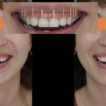 пластика десны лазером