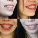 пластика десны после имплантации