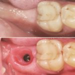 пластика десны после удаления зуба