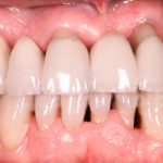 почему десна отходит от зуба