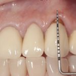 пульсирует десна над зубом