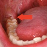 пульсируют десна зубов