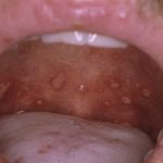 сепсис десны