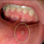 сепсис на десне