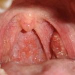 сепсис после удаления зуба мудрости