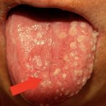 шелушится язык