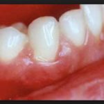 сильно пульсирует десна