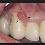 у ребенка на десне нарост как бородавка