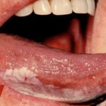 у ребенка облазит язык