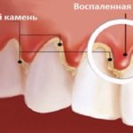 воспалена десна зуба