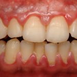 воспалилась десна под коронкой