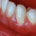 воспалилась десна под зубом