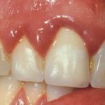 воспалилась десна с гноем