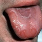 язык облазит и болит