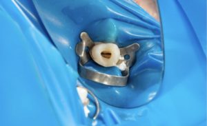 Девитализация зуба: процедура, показания, результаты
