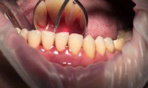 Лазерное лечение зубов — что и как лечить?
